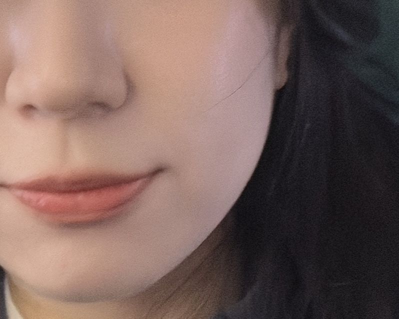 시술 10일 뒤 옅어진 팔자, 입가 주름과 보다 날렵해진 턱라인을 확인할 수 있었다