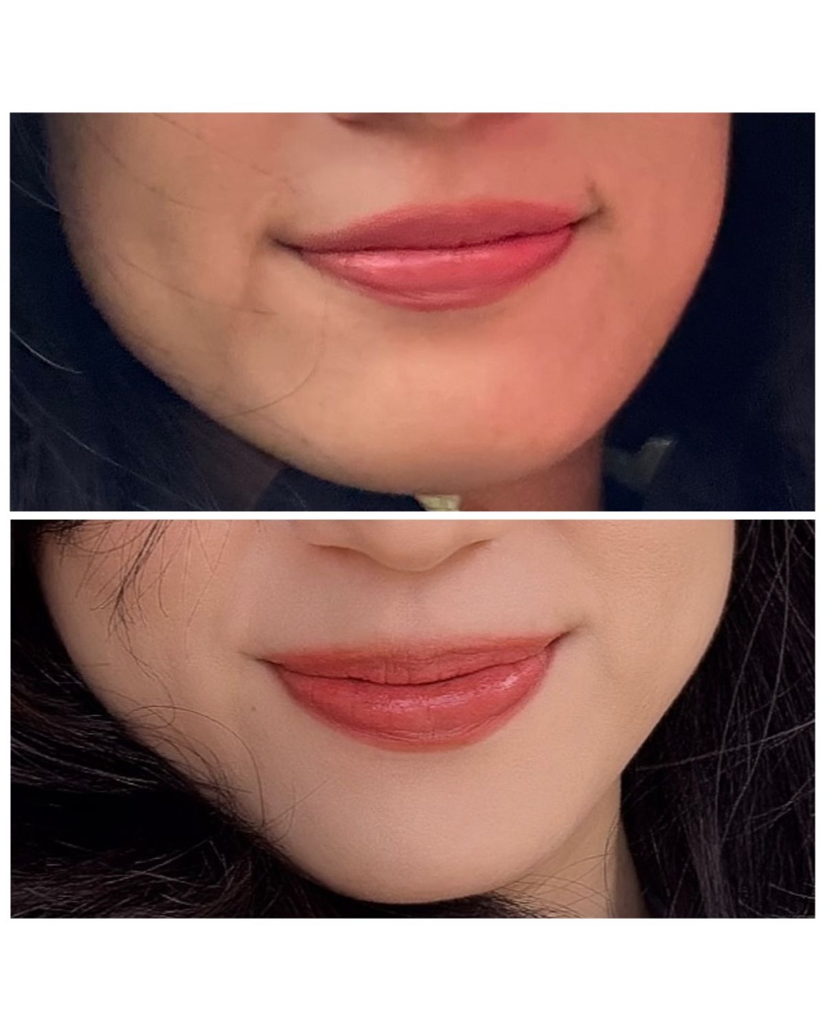 리프팅 시술 전과 후 미묘하게 정리된 턱라인